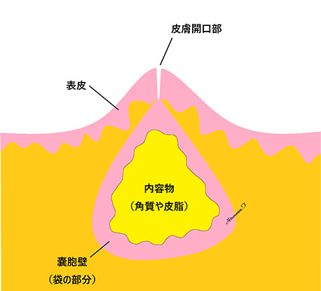 粉瘤（ふんりゅう）図