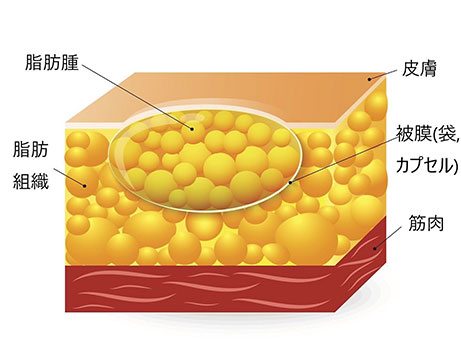脂肪腫（しぼうしゅ）図