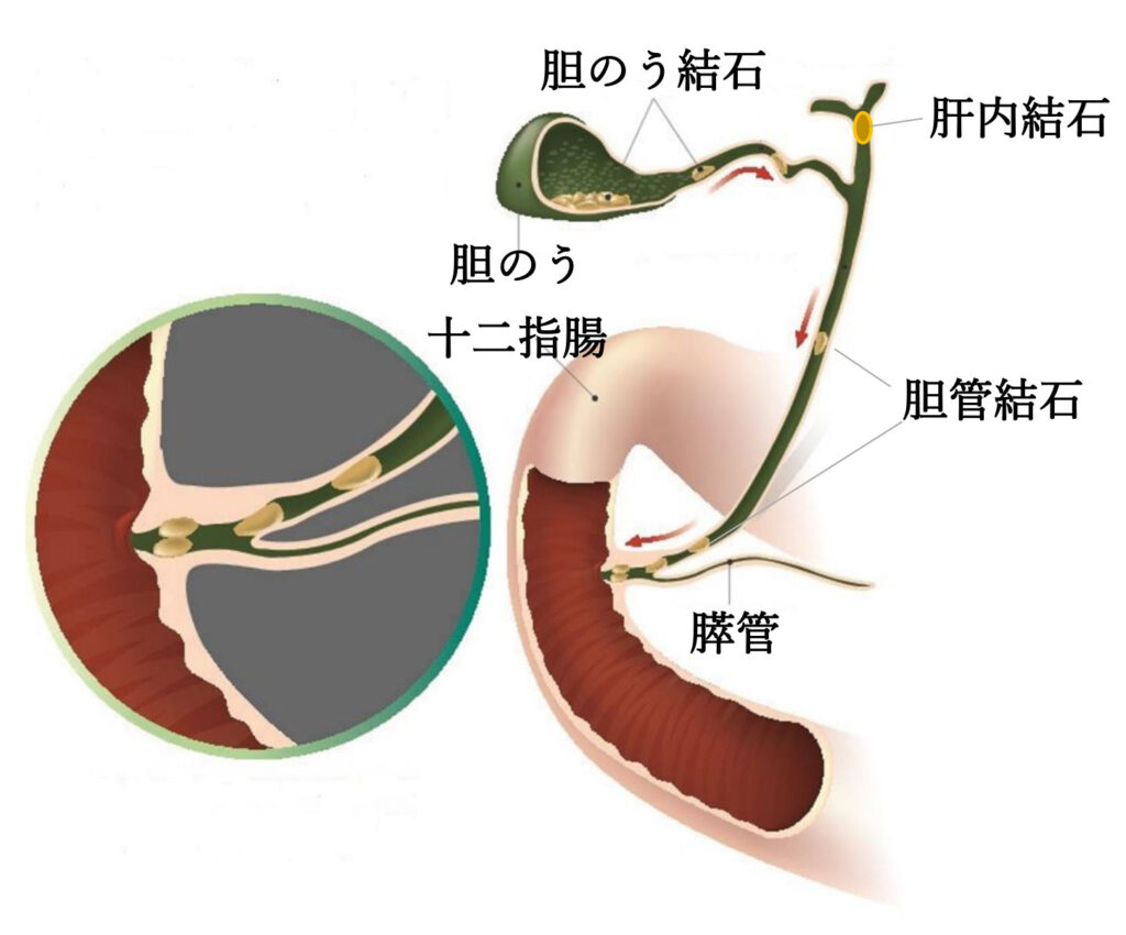 胆嚢 結石 非 充満 型 と は