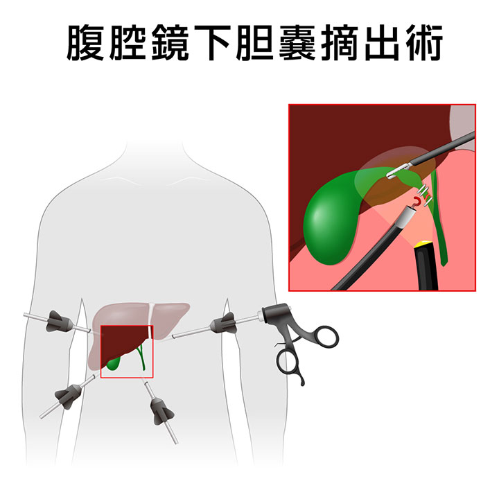 胆石症とは画像5