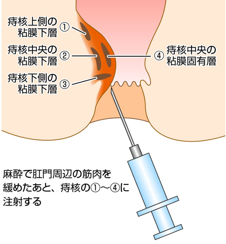 痔核画像6