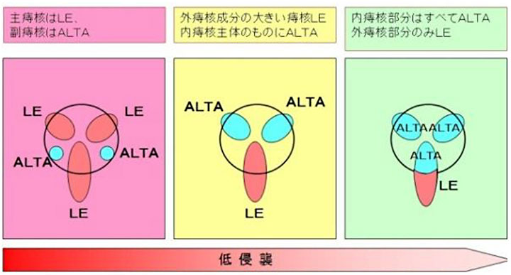 痔核画像7