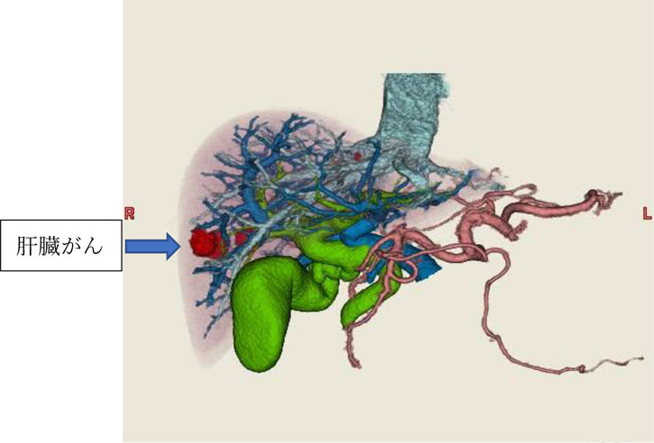 肝臓、胆道（胆嚢・胆管）、門脈、肝動脈、肝静脈の３次元構築画像