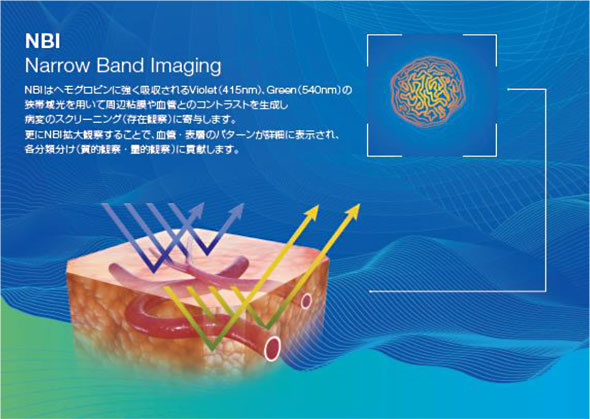 NBI(狭帯域光観察:Narrow Band Imaging)