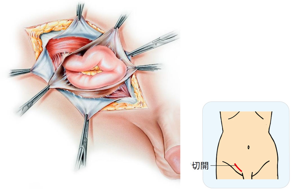 開腹手術