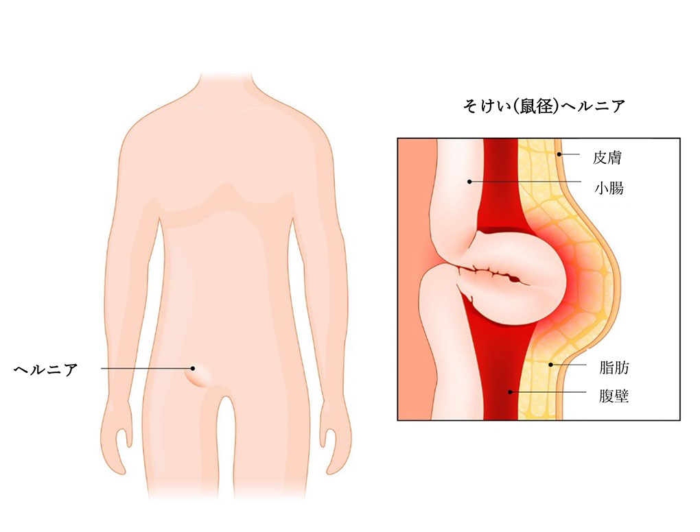 そけい(鼠径)ヘルニア