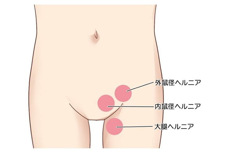 鼠径部のヘルニアは大きく3パターン