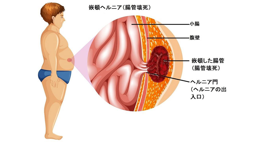 嵌頓(かんとん)ヘルニア