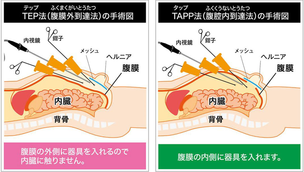 TEP法とTAAP法