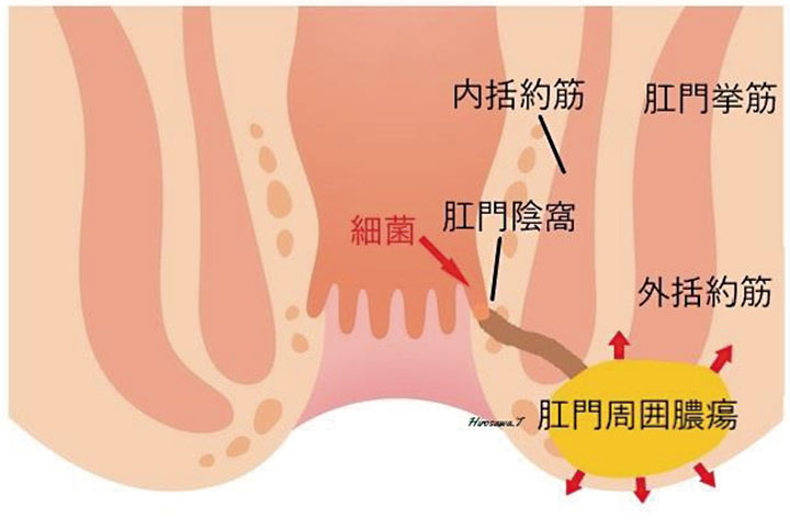 痔瘻（あな痔）