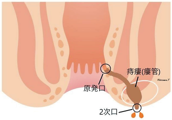 痔瘻(あな痔)2