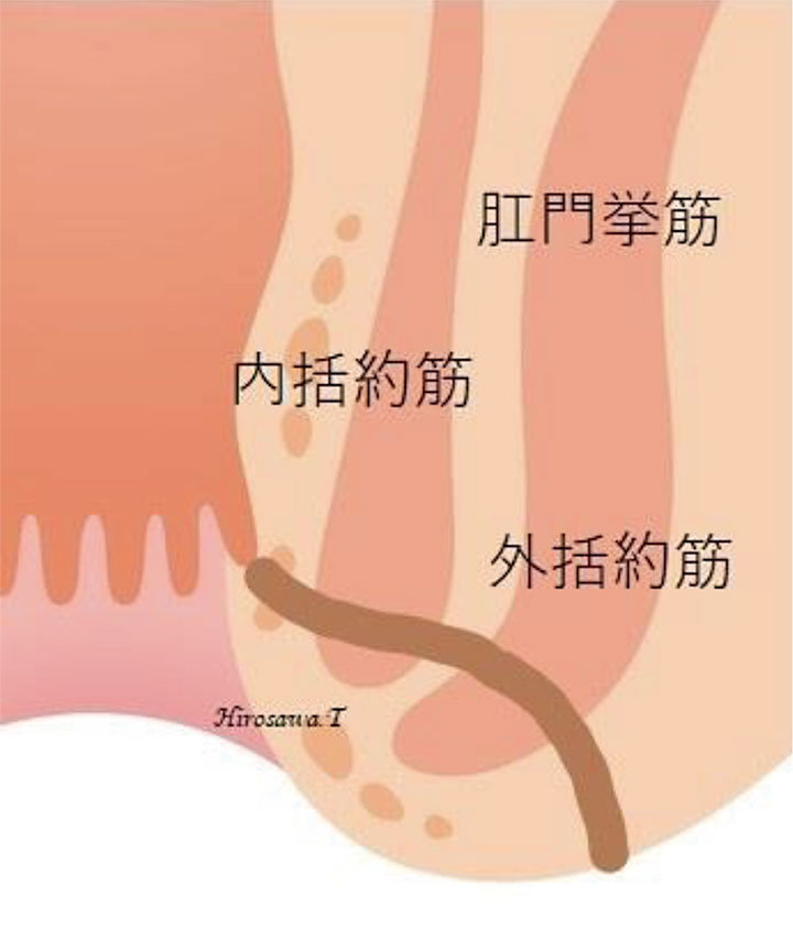 低位筋間痔瘻(単純痔瘻)