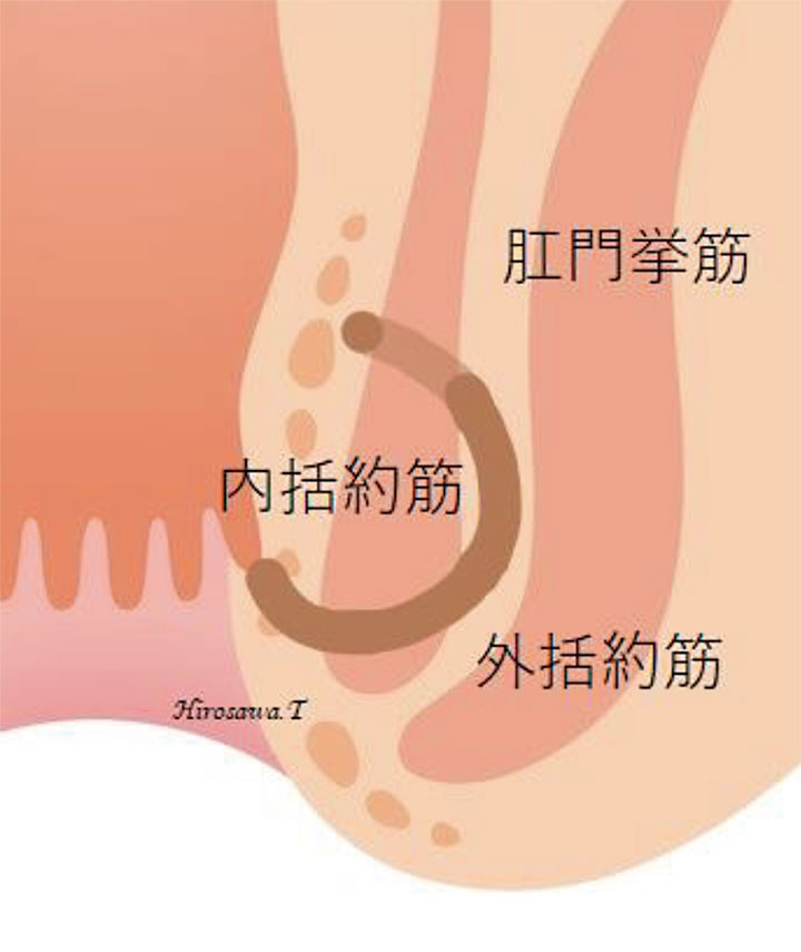 高位筋間痔瘻