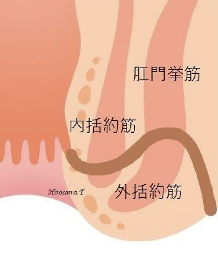 坐骨直腸窩痔瘻（深部痔瘻）