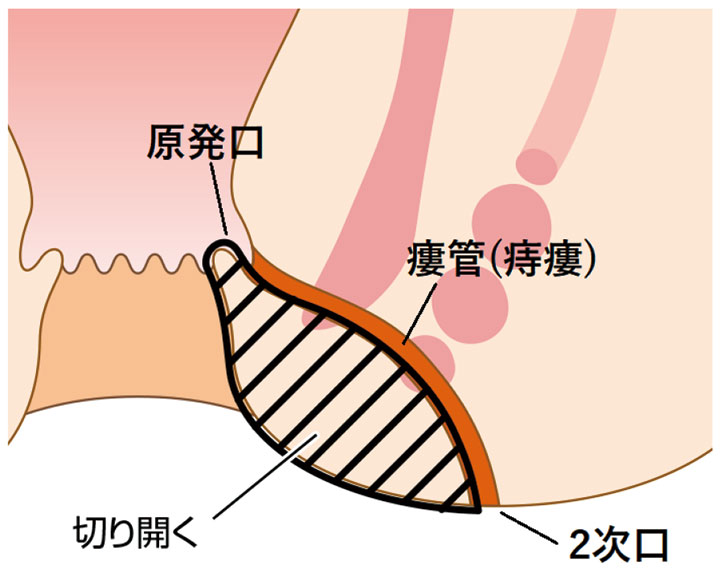 切開開放術（Lay Open法）