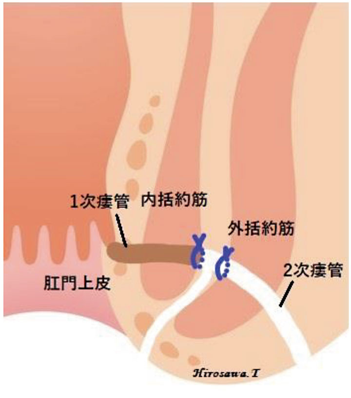 LIFT法