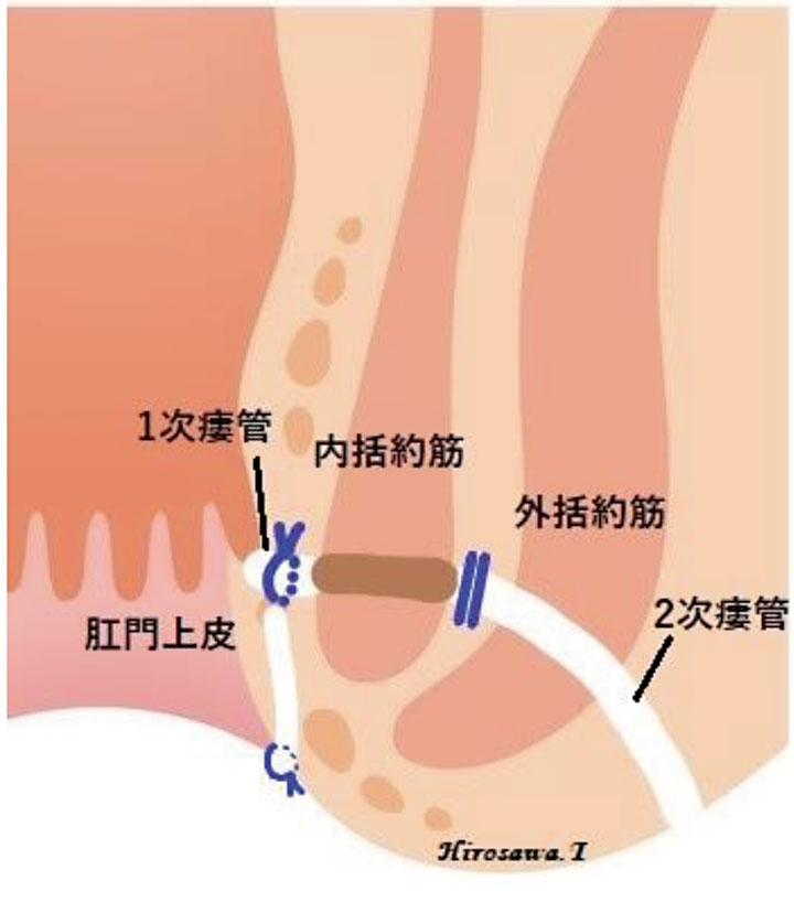 EACA法