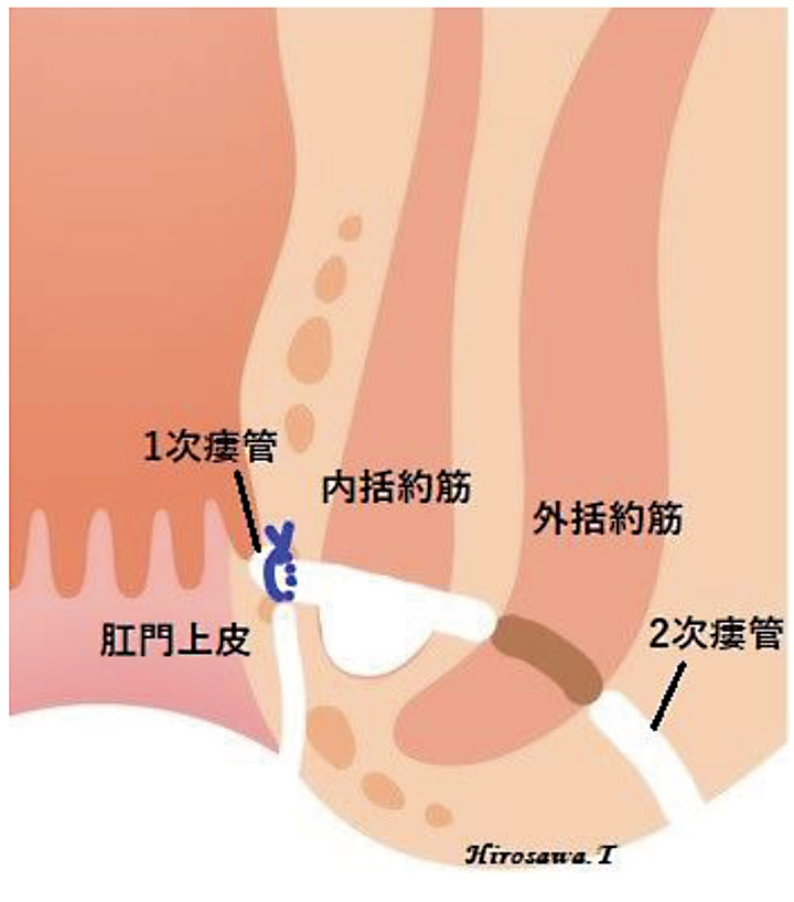 括約筋温存術