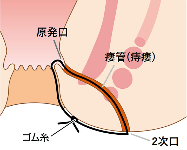 シートン法（Seton法）