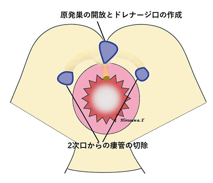 （外肛門括約筋）外側アプローチ法2