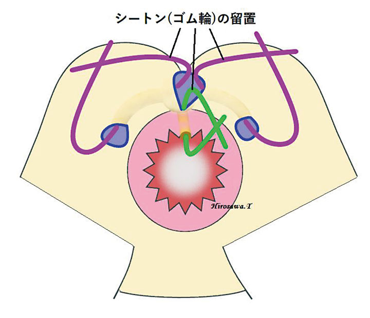 （外肛門括約筋）外側アプローチ法3