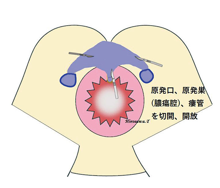 (外肛門括約筋)外側アプローチ法4