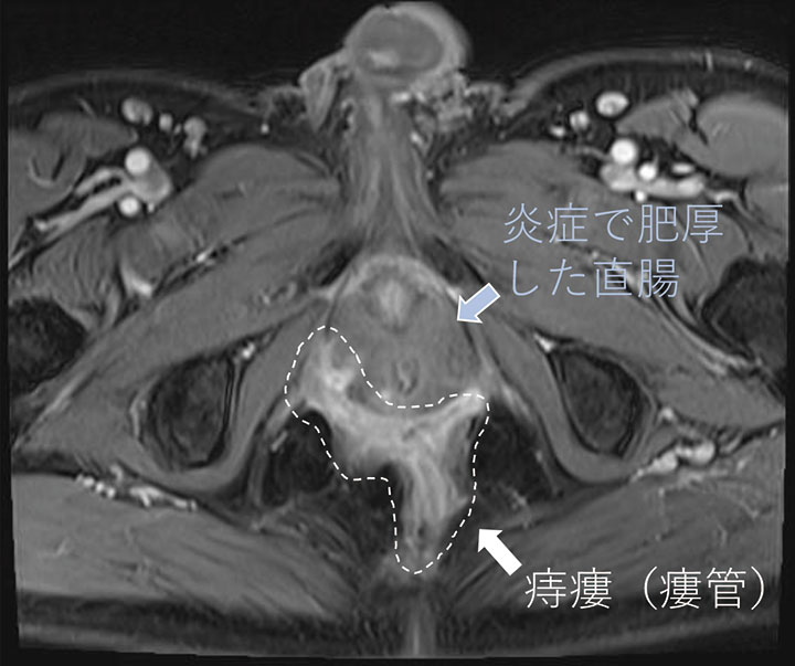 III型痔瘻(造影MRI)