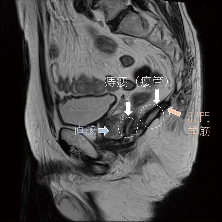 IV型痔瘻(造影MRI)