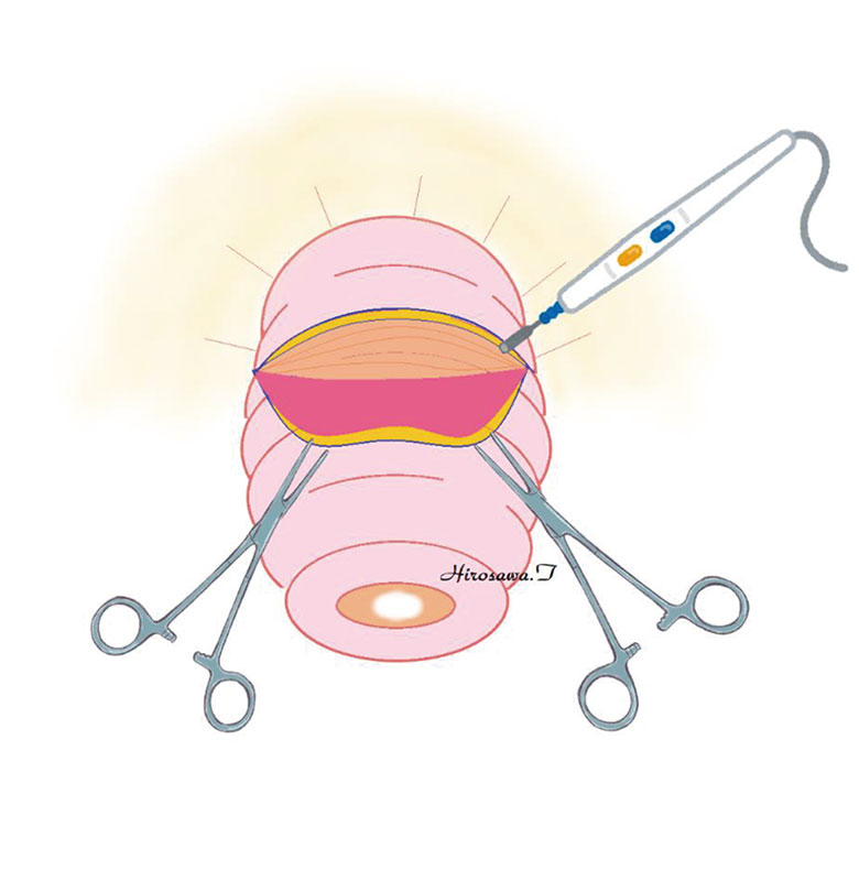 脱出した直腸の表面の粘膜を、末端方向に向かって電気メスで剥離（はくり：はがすこと）していく。