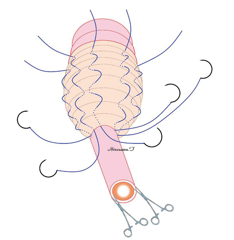 直腸粘膜を剥離した後、露出した筋層を円筒状に糸で縫縮する。