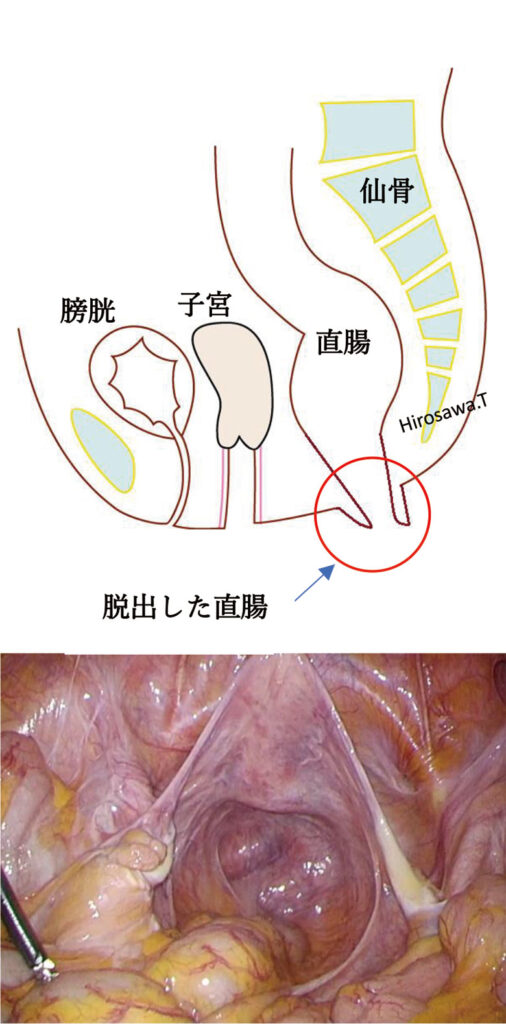 直腸脱に特有の深い骨盤底