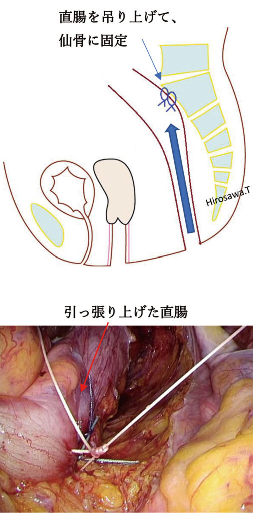 仙骨に糸で固定しているところ