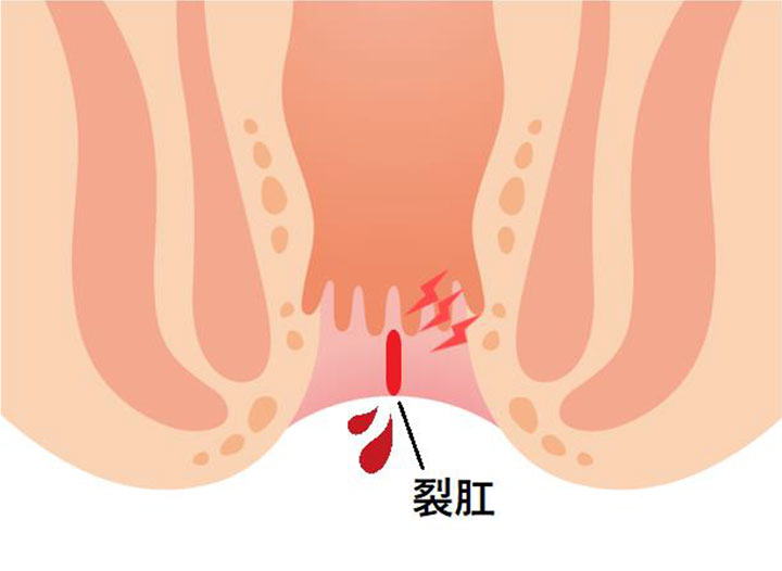 裂肛(切れ痔)とは