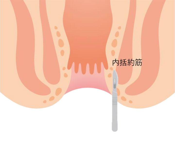 側方内括約筋切開術