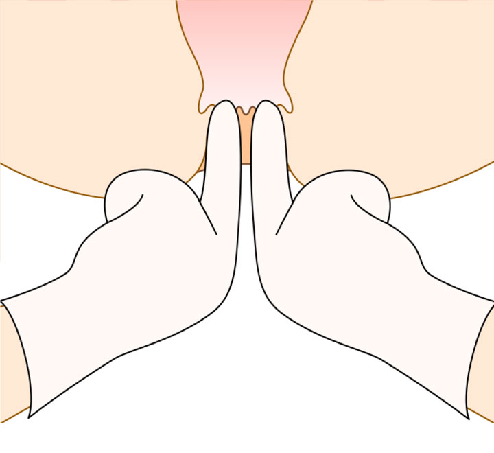 用手肛門拡張術