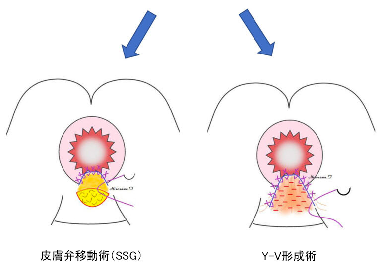 皮膚弁移動術(SSG)／ Y-V形成術