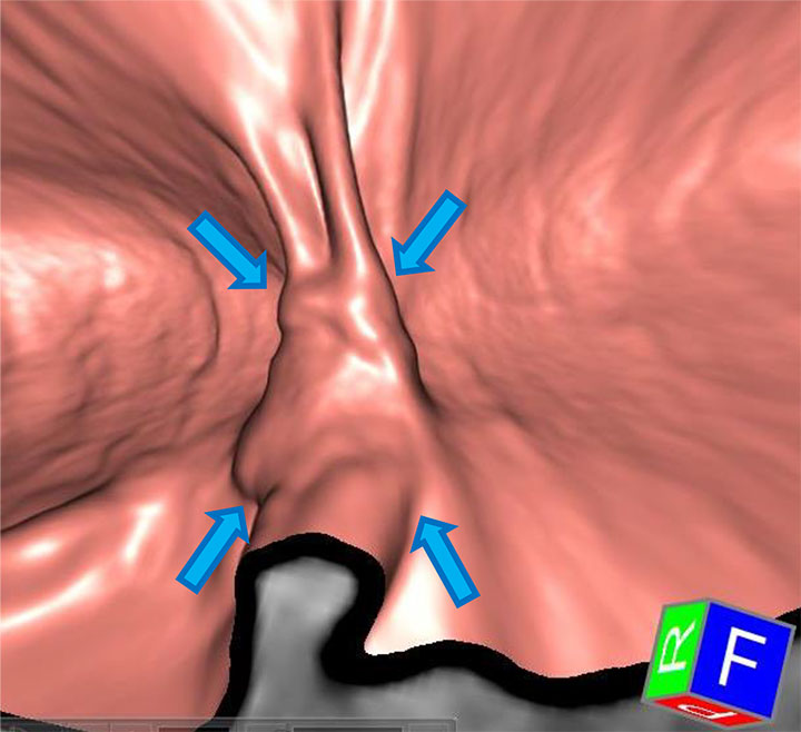 大腸3D-CT検査で、横行結腸に大腸がんを疑う腫瘍性病変