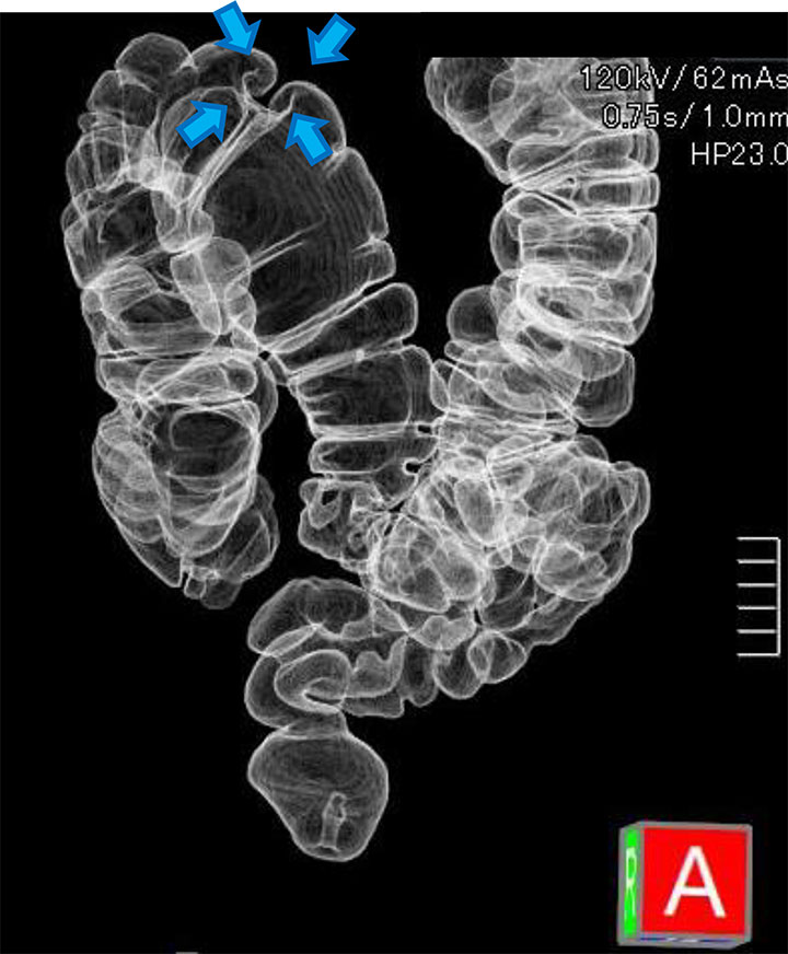 仮想大腸構築画像にて腫瘍性病変の位置と性状が一目瞭然