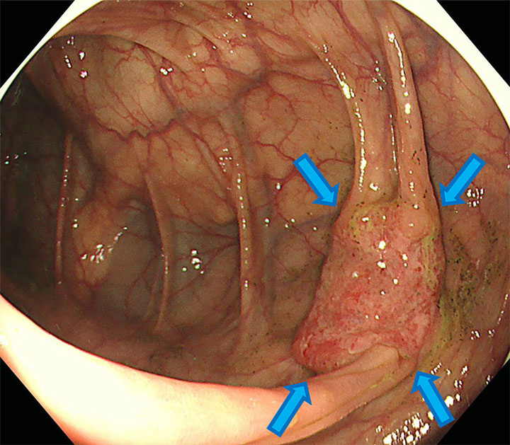 精密検査の大腸内視鏡検査で大腸3D-CTと極めて再現性の高い画像所見