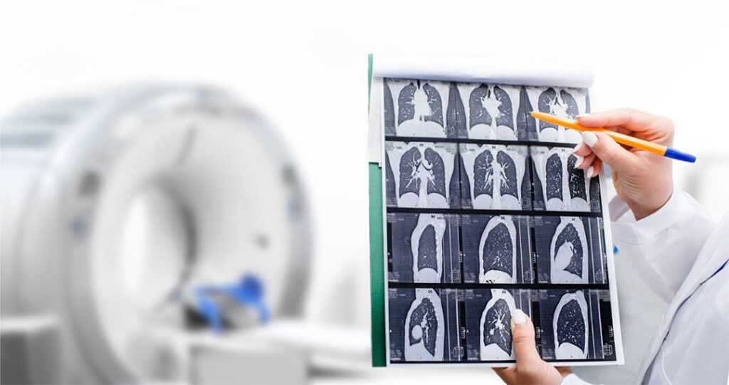 肺CT検査