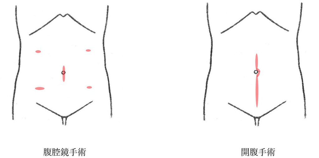 腹腔鏡手術と開腹手術