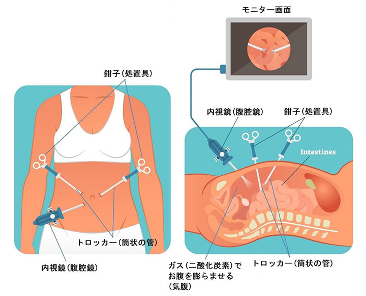 内視鏡外科手術の流れ