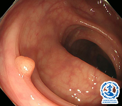 大腸ポリープ(大きさ5~6mm程度)