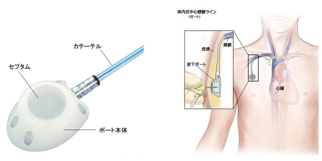 中心静脈ポート(CVポート)造設手術