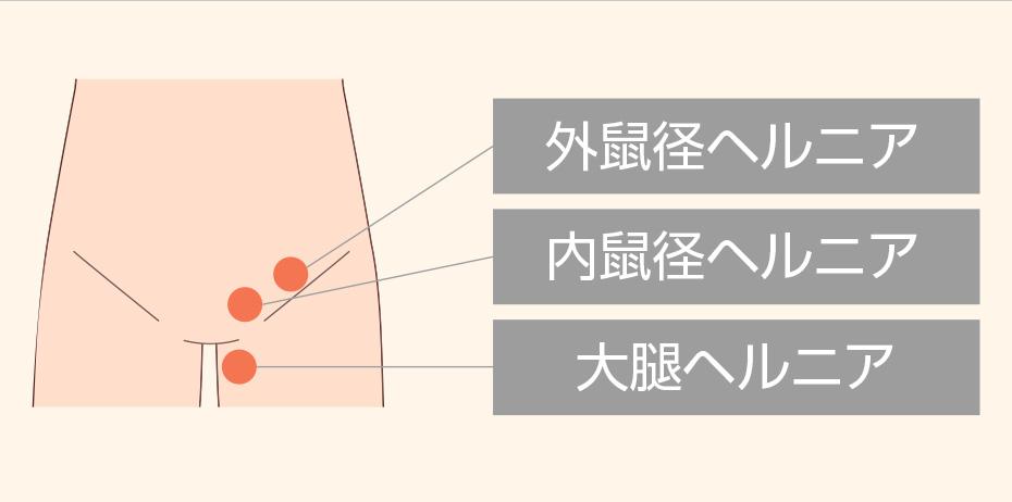 鼠径ヘルニアの分類