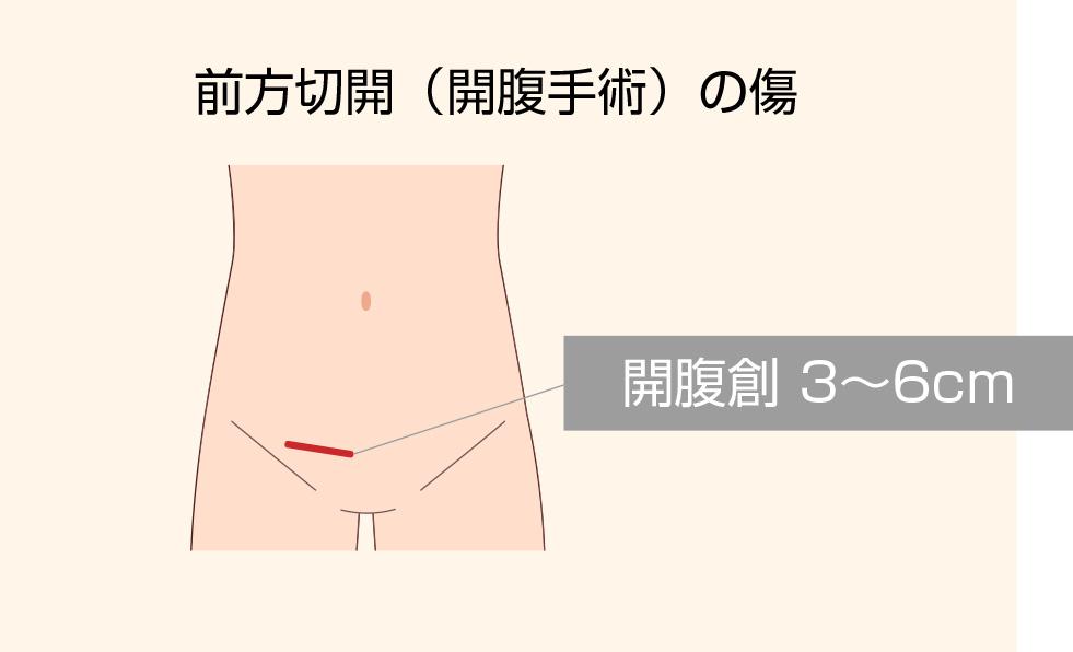 前方切開法（開腹手術）の傷