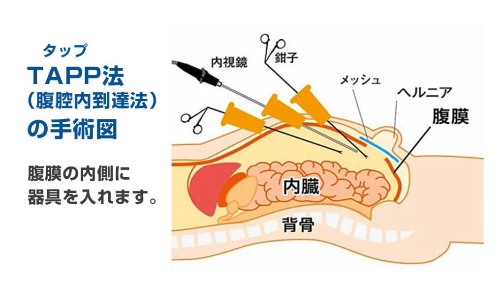 TAPP法