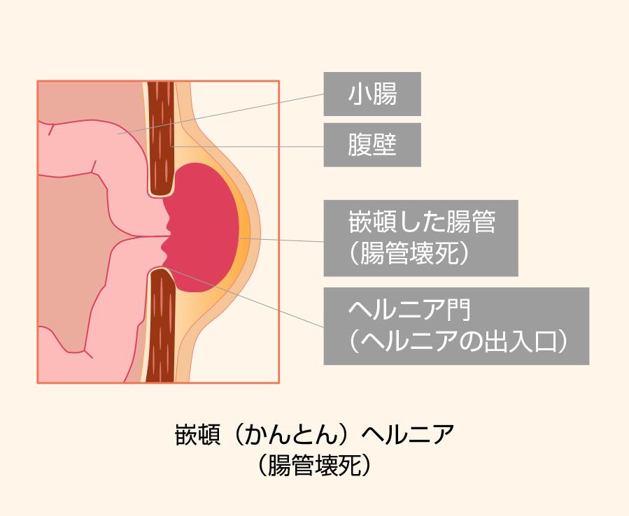 嵌頓（かんとん）ヘルニア