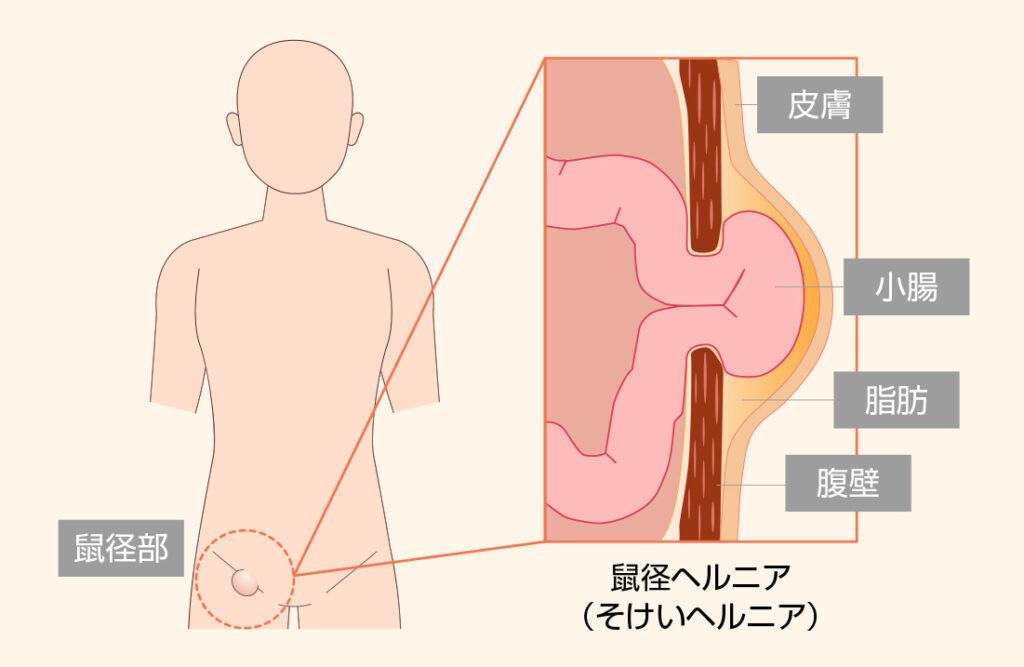 鼠径ヘルニア