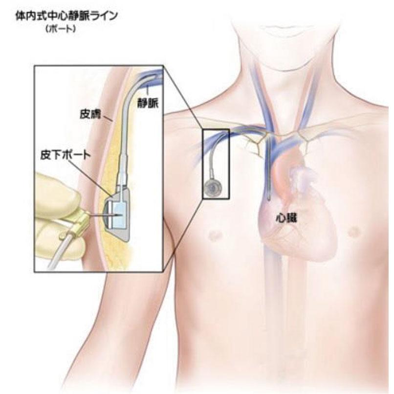 中心静脈ポート2